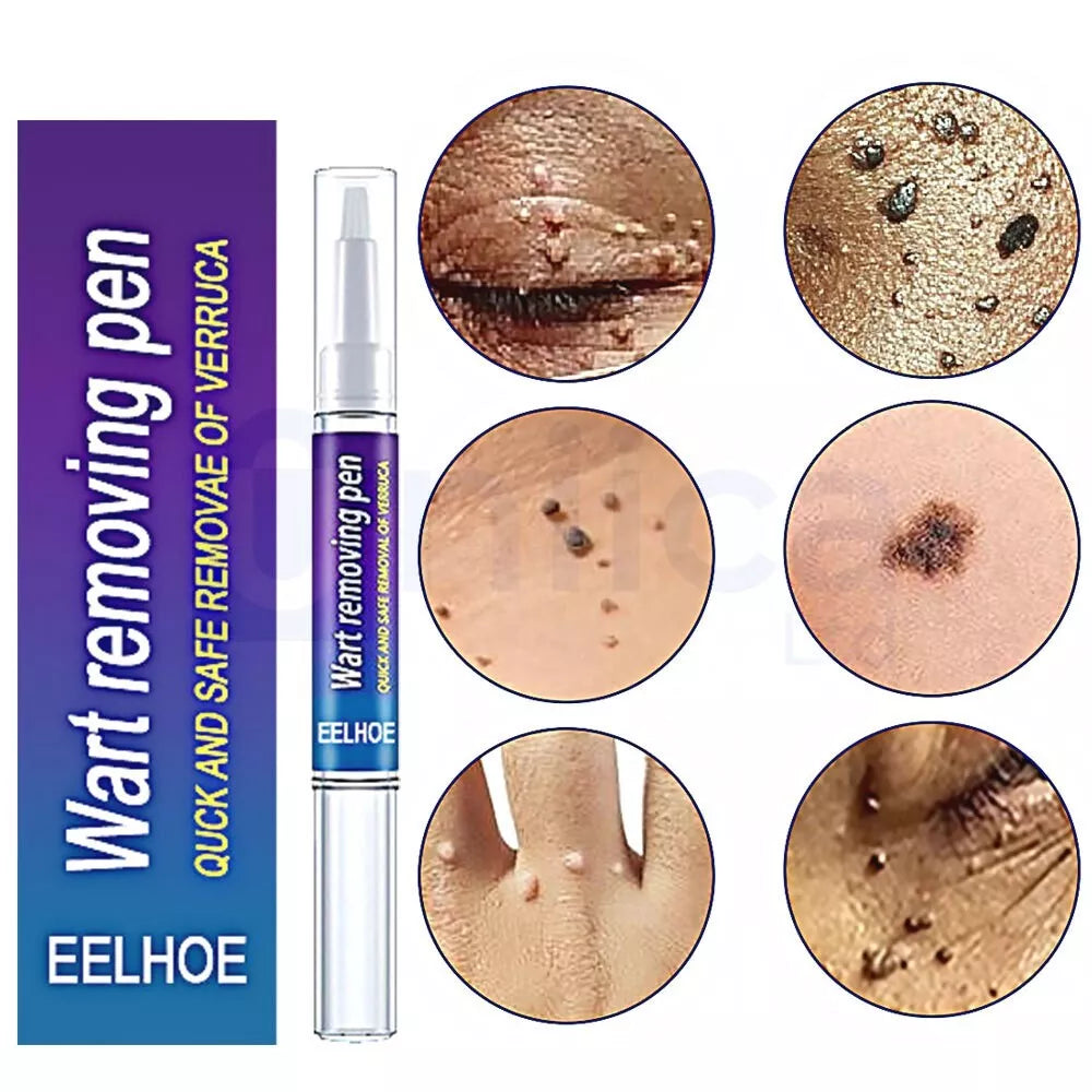 Wart Remover Pen, Skin Treatment, Mole Remover